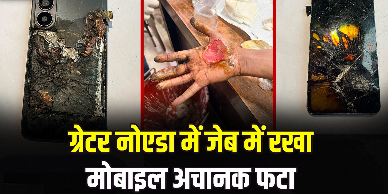 ग्रेटर नोएडा में जेब में रखा मोबाइल अचानक फटा, युवक के दोनों हाथ और प्राइवेट पार्ट झुलसे; एक महीने पुराना था फोन