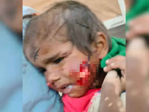 गाजियाबाद: 1 साल की बच्ची के चेहरे का मांस नोंच ले गए, डॉक्टर टांके तक नहीं लगा पाए; अब सर्जरी होगी