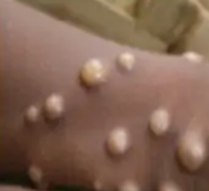 गाजियाबाद में मिला मंकीपॉक्स का संदिग्ध केस